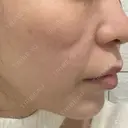 ピコレーザートーニング（美白・肝斑） APスキンクリニック銀座 DAY 0 サムネイル用