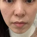 ピコレーザートーニング（美白・肝斑） APスキンクリニック銀座 AFTER サムネイル用