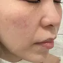 ピコレーザートーニング（美白・肝斑） APスキンクリニック銀座 DAY 0 サムネイル用