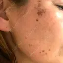 シミ取りレーザー S-Laboクリニック 渋谷院 DAY 7 サムネイル用