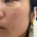 イオン導入 / ピコレーザートーニング（美白・肝斑） ルラ美容クリニック 渋谷本院 AFTER サムネイル用
