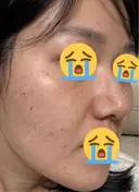 美肌レーザー / LDM・インテンスウルトラ ライズワン美容皮膚科クリニック DAY 2 サムネイル用