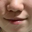 ボトックス（ガミースマイル） ちぐさ内科クリニック 覚王山 DAY 1 サムネイル用