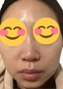 脂肪溶解注射（顔） 上野注入クリニック DAY 3 サムネイル用