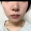 イオン導入 / 毛穴洗浄（ハイドラフェイシャルなど） / ルメッカ ルラ美容クリニック 岡山院 DAY 7 サムネイル用