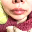 ヒアルロン酸注入（唇） KIMI CLINIC 形成・美容外科 AFTER サムネイル用