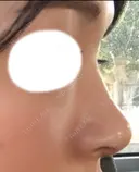 隆鼻術 / 鼻尖形成（切開） / 鼻中隔延長（切開） / 鼻尖縮小 FROM B整形外科 (旧バウム整形外科) DAY 39 サムネイル用