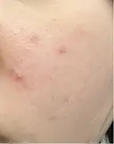 エレクトロポレーション / 毛穴洗浄（ハイドラフェイシャルなど） Fellez Clinic【フェルズクリニック】 DAY 12 サムネイル用
