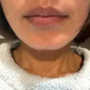 デンシティ 城本クリニック 新宿院 DAY 1 サムネイル用