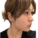 その他（肌） / インモード 東京美容皮膚科アロエクリニック池袋 AFTER サムネイル用