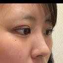 二重埋没 湘南美容クリニック 千葉センシティ院 DAY 0 サムネイル用