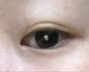 二重埋没 湘南美容クリニック 松山院 DAY 128 サムネイル用