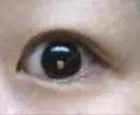 二重埋没 湘南美容クリニック 松山院 AFTER サムネイル用