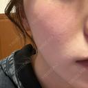 エレクトロポレーション BITO BEAUTY CLINIC AFTER サムネイル用