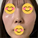 鼻尖形成（切開） / 鼻中隔延長（切開） / 軟骨移植 / 眉間プロテーゼ eクリニック 福岡院 DAY 48 サムネイル用