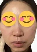 脂肪溶解注射（顔） 上野注入クリニック DAY 4 サムネイル用