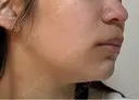 ポテンツァ L‘amour clinic Tokyo【ラムールクリニック東京】 DAY 3 サムネイル用