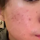 フラクショナルレーザー（毛穴・ニキビ跡） しらゆりメディカルクリニック （旧しらゆりビューティークリニック） DAY 0 サムネイル用