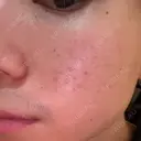 フラクショナルレーザー（毛穴・ニキビ跡） しらゆりメディカルクリニック （旧しらゆりビューティークリニック） DAY 0 サムネイル用