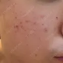 フラクショナルレーザー（毛穴・ニキビ跡） しらゆりメディカルクリニック （旧しらゆりビューティークリニック） AFTER サムネイル用