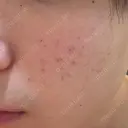 フラクショナルレーザー（毛穴・ニキビ跡） しらゆりメディカルクリニック （旧しらゆりビューティークリニック） DAY 4 サムネイル用