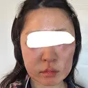 脂肪吸引注射（顔） 新宿美容外科ネビュラクリニック DAY 1 サムネイル用