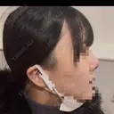鼻尖形成（切開） / 軟骨移植 / 眉間プロテーゼ BAYASHI CLINIC DAY 3 サムネイル用