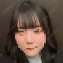 鼻尖形成（切開） / 軟骨移植 / 眉間プロテーゼ BAYASHI CLINIC AFTER サムネイル用