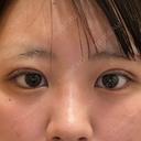 二重埋没 湘南美容クリニック 千葉センシティ院 DAY 1 サムネイル用