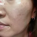 光治療（フォトフェイシャルなど） しんゆり美容健康クリニック DAY 0 サムネイル用