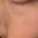 その他（目元） 品川スキンクリニック広島院 DAY 11 サムネイル用