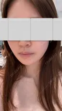 バッカルファット除去 / 脂肪吸引（顔） First Clinic AFTER サムネイル用