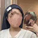 ボトックス（エラ・小顔） / ボトックス（額） / ボトックス（首） Next Tokyo Clinic DAY 7 サムネイル用