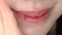 口唇縮小術 Stand by Beauty Clinic AFTER サムネイル用