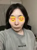 ソフウェーブ アンリクリニック 名古屋院 DAY 4 サムネイル用