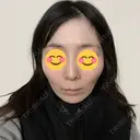 ソフウェーブ アンリクリニック 名古屋院 DAY 5 サムネイル用