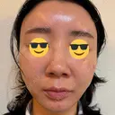 糸リフト / 脂肪吸引（顔） EMMA CLINIC（エマクリニック） DAY 31 サムネイル用