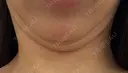 その他（輪郭） 美容皮膚科エルムクリニック 大阪院 DAY 39 サムネイル用