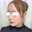 鼻尖形成（切開） / 軟骨移植 / 鼻修正 / 鼻孔縁挙上 / その他（鼻） WOM CLINIC GINZA （ワム クリニック ギンザ） DAY 31 サムネイル用