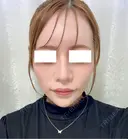 鼻尖形成（切開） / 軟骨移植 / 鼻修正 / 鼻孔縁挙上 / その他（鼻） WOM CLINIC GINZA （ワム クリニック ギンザ） AFTER サムネイル用