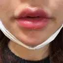 ヒアルロン酸注入（涙袋） / ボトックス（あご） / ボトックス（エラ・小顔） / ヒアルロン酸注入（唇） / ボトックス（眉間） / ボトックス（目尻） / ボトックス（額） DMTC美容皮膚科 大宮院 AFTER サムネイル用
