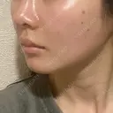 ヒアルロン酸注入（頬） / ヒアルロン酸注入（鼻翼基部） KIMI CLINIC 形成・美容外科 DAY 30 サムネイル用