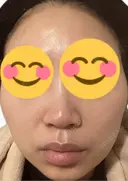 脂肪溶解注射（顔） 上野注入クリニック DAY 6 サムネイル用