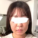 脂肪吸引注射（顔） 新宿美容外科ネビュラクリニック DAY 3 サムネイル用