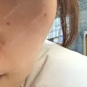 ピコスポット APスキンクリニック銀座 AFTER サムネイル用