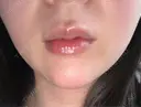 ヒアルロン酸注入（あご） / ボトックス（エラ・小顔） / インモード ルラ美容クリニック 新潟院 AFTER サムネイル用
