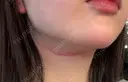 ヒアルロン酸注入（あご） / ボトックス（エラ・小顔） / インモード ルラ美容クリニック 新潟院 DAY 2 サムネイル用