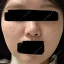 その他（肌） レナータクリニック 立川院 AFTER サムネイル用