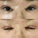 二重切開 / 目頭切開 EMMA CLINIC（エマクリニック） DAY 1 サムネイル用