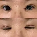 二重切開 / 目頭切開 EMMA CLINIC（エマクリニック） DAY 7 サムネイル用